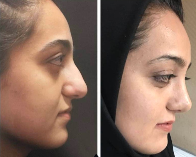 تجربتي مع التجميل في تركيا