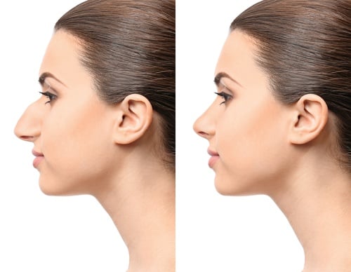 تجربتي مع تجميل الانف في تركيا